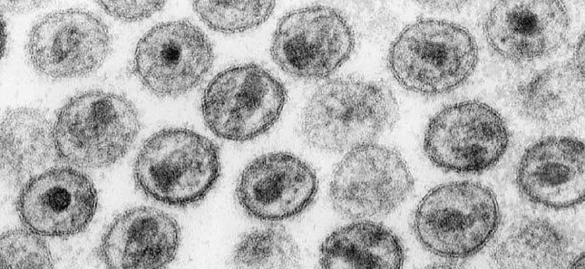 Identifican nueva variante del VIH altamente contagiosa