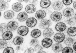 Identifican nueva variante del VIH altamente contagiosa