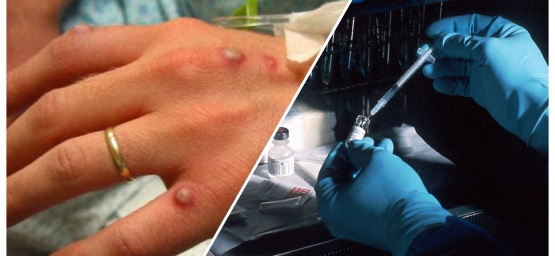Viruela de mono: El brote que tiene al mundo en vilo, se han detectado casos en Europa y EEUU