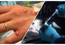 Viruela de mono: El brote que tiene al mundo en vilo, se han detectado casos en Europa y EEUU