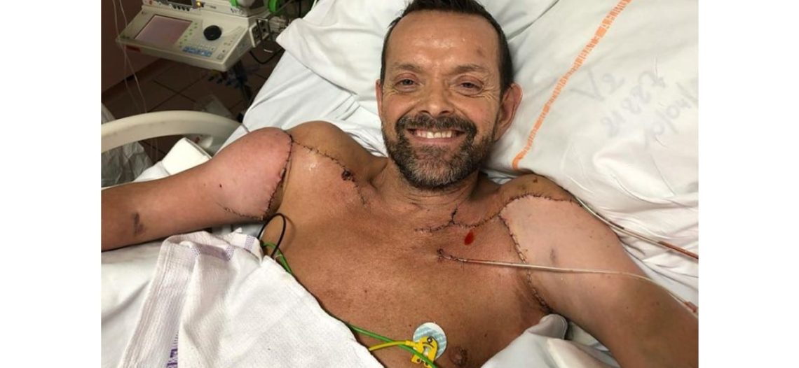 La increíble historia de Felix, el primer hombre en recibir un trasplante de brazos