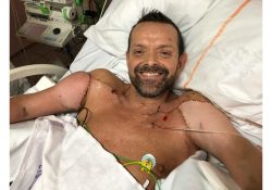 La increíble historia de Felix, el primer hombre en recibir un trasplante de brazos