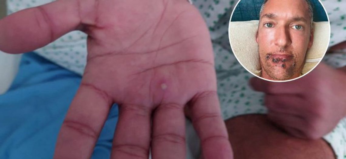 Actor porno relata su experiencia con la viruela del mono: “No se lo desearía ni a mi peor enemigo”