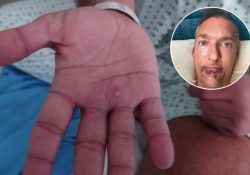 Actor porno relata su experiencia con la viruela del mono: “No se lo desearía ni a mi peor enemigo”
