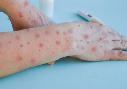 Estados Unidos declara alerta máxima por viruela; suman 6,600 casos