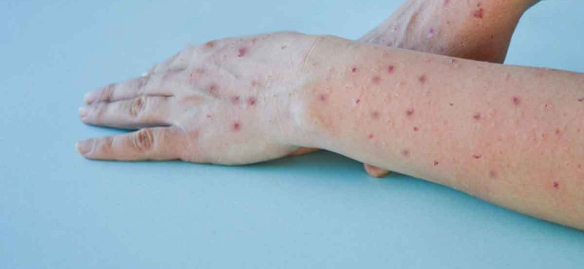 Confirman muerte por viruela del mono en Los Ángeles; sería primer deceso a causa del virus en EEUU