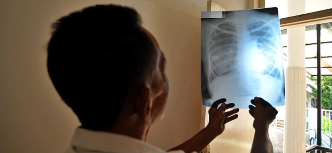 La Tuberculosis Vuelve a Propagarse en el Mundo: OMS