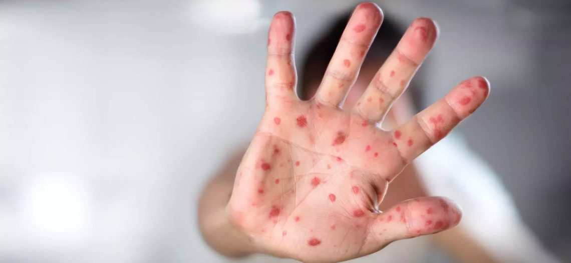 Secretaría de Salud emite nuevo aviso epidemiológico por sarampión