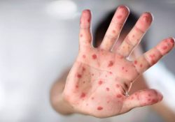 Secretaría de Salud emite nuevo aviso epidemiológico por sarampión