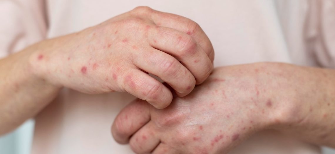 OPS emite alerta epidemiológica por sarampión; México más de 6 mil casos