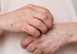 OPS emite alerta epidemiológica por sarampión; México más de 6 mil casos