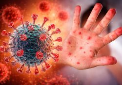 Incremento de sarampión amenaza el control epidemiológico en México