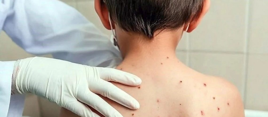 México registra 133 casos de sarampión en las primeras semanas de clases
